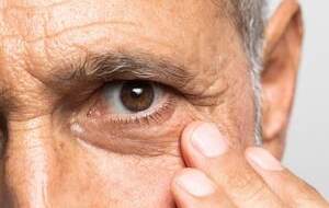 علت پف زیر چشم