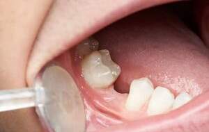 راه‌های کاهش پوسیدگی دندان