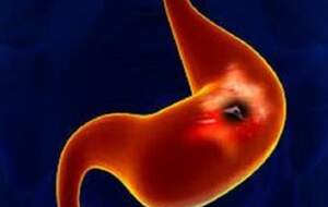 ۵ سرطان کشنده در ایران