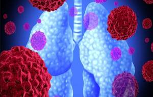 داروی جدید برای سرطان کُشنده ریه تأیید شد