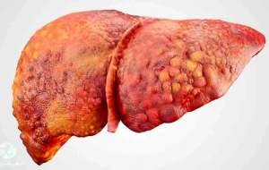 یک‌سوم ایرانی‌ها کبد چرب دارند