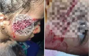 حمله سگ‌های ولگرد ‌به دختر ۵ ساله تبریزی