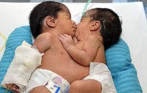 جداسازی مو‌فقیت‌آمیز دوقلو‌های بهم چسبیده