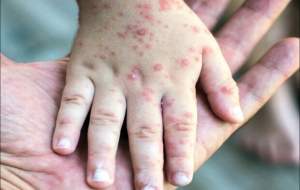 نکات مهم برای پیشگیری از سرخک در اربعین