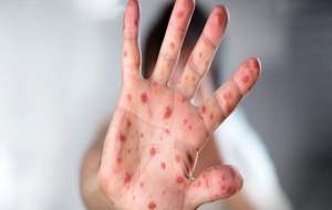 شیوع سرخک در عراق