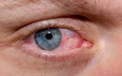 این بیماری چشمی را به سادگی درمان کنید