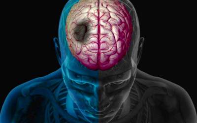 آمار سکته مغزی در کدام استان‌ها بیشتر است