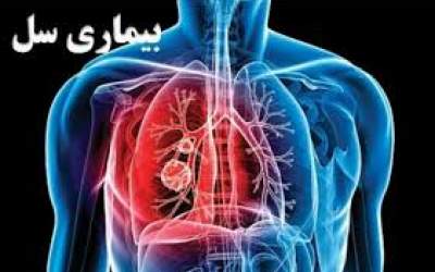 با اقدامات پیشگیرانه در برابر سل آشنا شویم