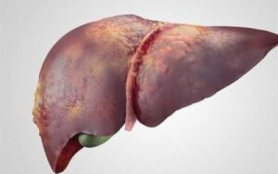 بهترین راه درمان کبد چرب چیست؟