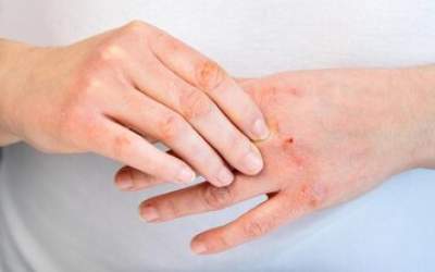 ۵ توصیه مهم برای مراقبت از پوست در سرما