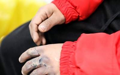 بهترین اقدام بعد از سوختگی