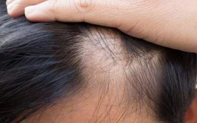 اینفوگرافی/ ۶ بیماری‌ ریزش مو