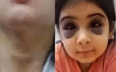 ضرب و شتم هولناک دختربچه ۹ ساله