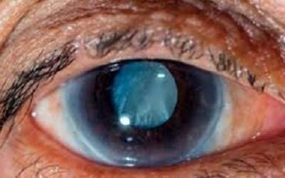 آب سیاه مترادف با نابینایی است؟