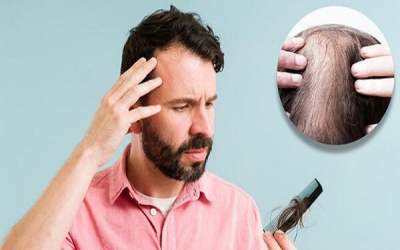 شایع‌ترین علت ریزش مو چیست؟