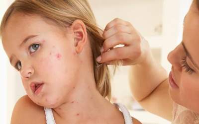 رکورد ابتلا به سرخک در اروپا و آمریکا شکسته شد