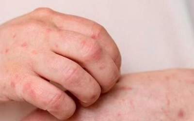 آبله مرغان، بیماری شایع فصل بهار