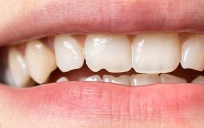 خوردن تخمه باعث فاصله افتادن بین دندان‌ها می‌شود؟