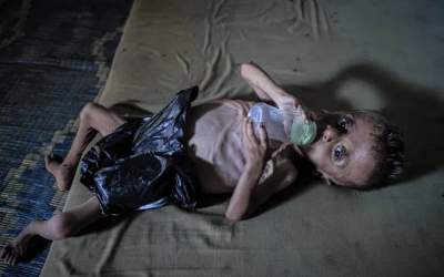 کودکان غزه تبدیل به پوست و استخوان شده‌اند