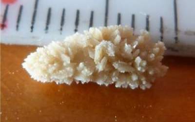 رباتی که سنگ کلیه را دفع می‌کند