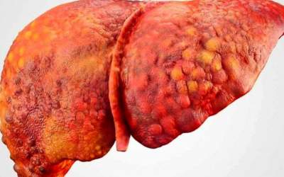 نوشابه ابتلا به کبد چرب را ۴ برابر می کند