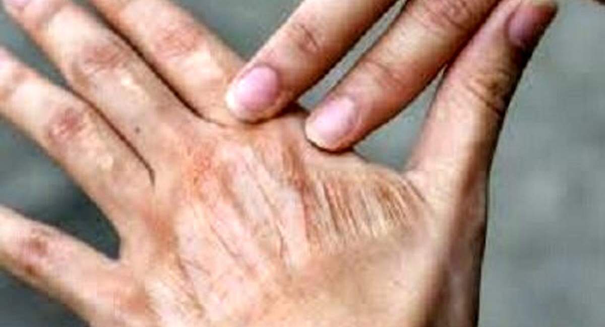چگونه از خشکی پوست در پاییز جلوگیری کنیم؟
