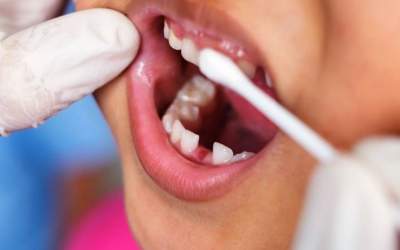 دبستانی‌ها به طور میانگین ۵ دندان پوسیده دارند