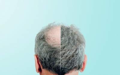 درمان طاسی سر با یک شیرین‌کننده طبیعی