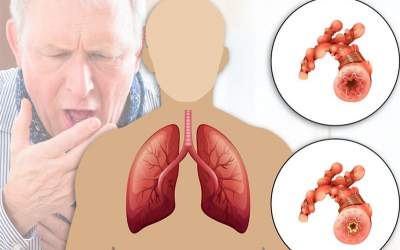 ابتلای ۱۰ میلیون ایرانی به آسم و انسداد ریوی