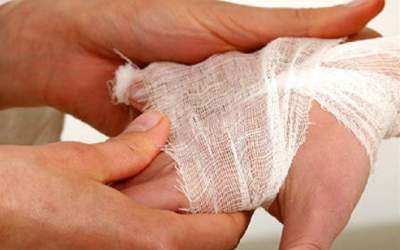 بستری سالانه ۳۰ هزار نفر بر اثر سوختگی